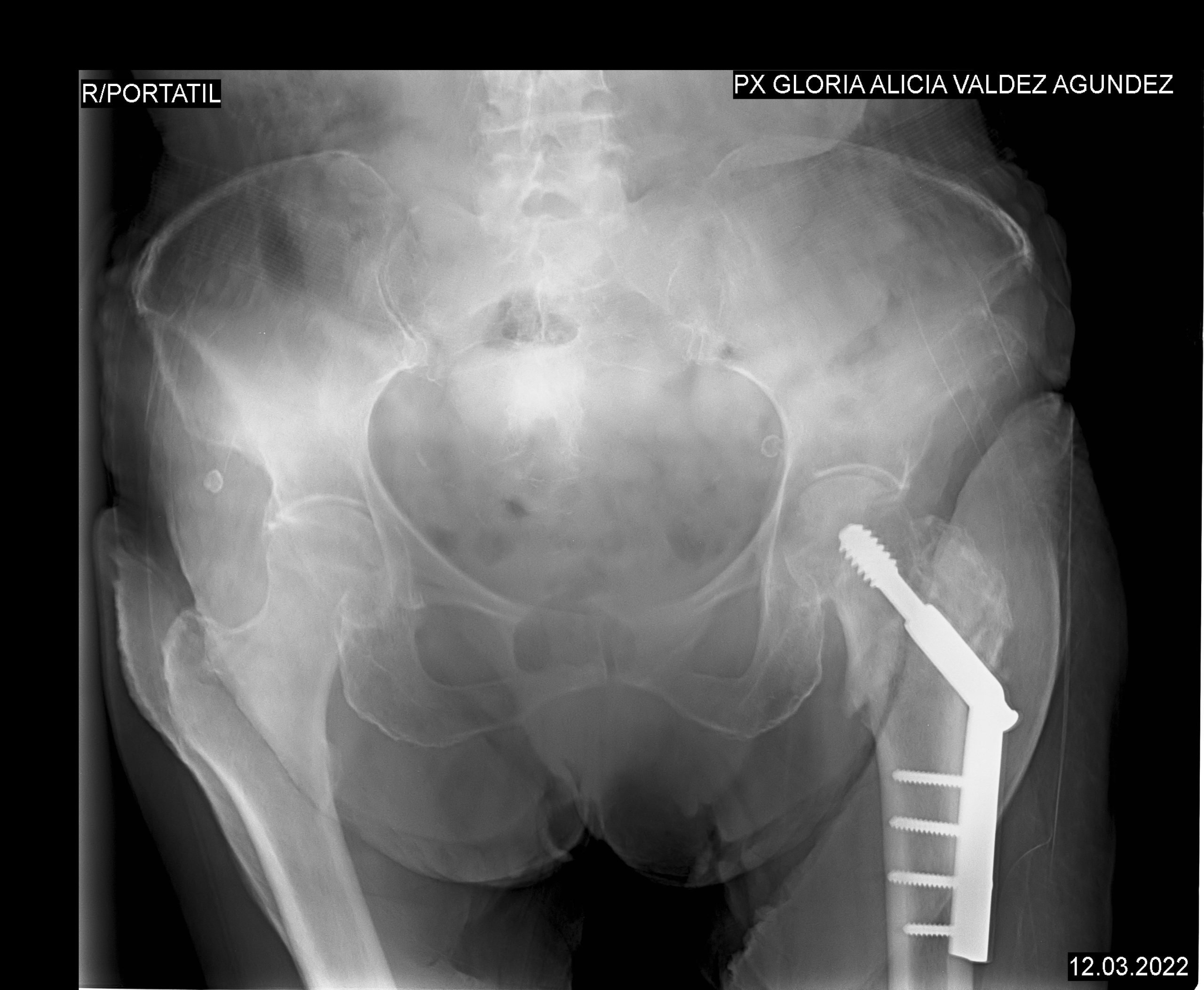 Radiografia de pelvis