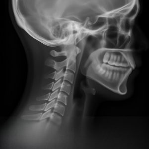 Radiografia lateral de columna cevical